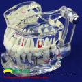 DENTAL08 (12567) Restauração de modelos de dentes de doença de implante dentário transparente